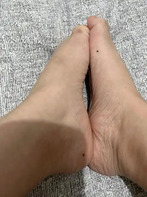 脚上长痣