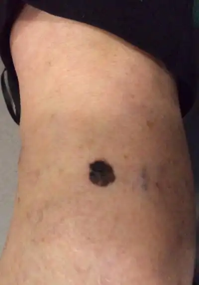 容易癌变的黑痣图片6