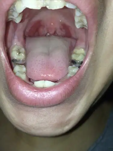 为什么我的小孩每个月发高烧和喉咙发炎,要吃什么才能提高免疫力?