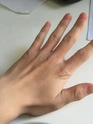 手背干燥怎么办 我16岁 很讨厌擦护手霜 油什么的.