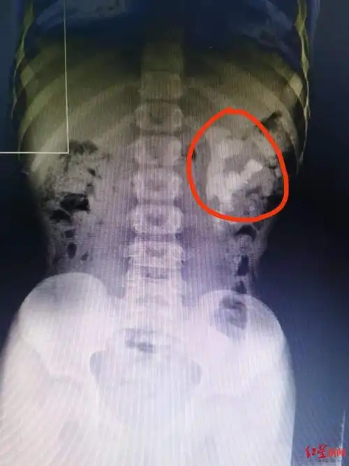 惊呆6月龄男婴输尿管下段被结石堆满这是怎么回事