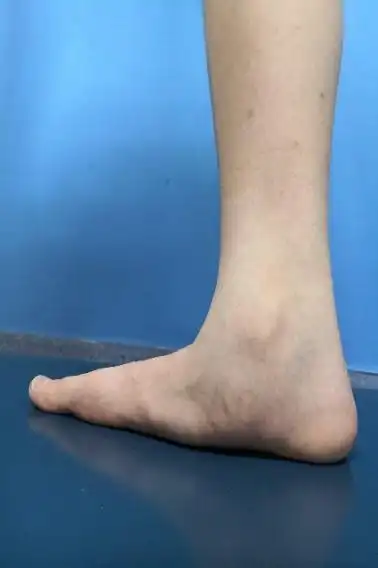 发现孩子扁平足怎么办