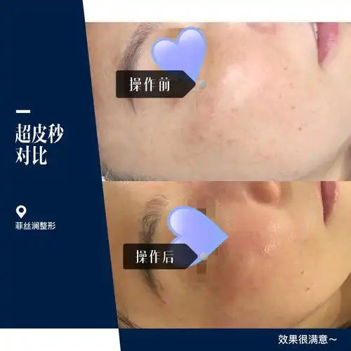 朋友做的超皮秒效果对比