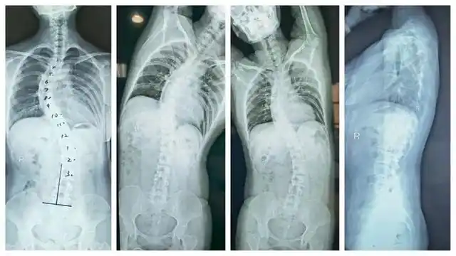 孩子脊柱侧弯严重吗小孩脊柱侧弯严重吗