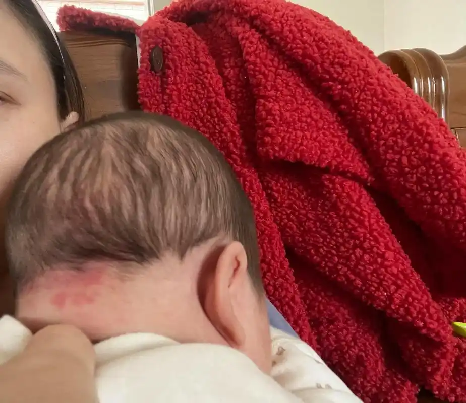 宝宝后脑勺出生的时候就有红色的胎记,医生说长大 - 抖音