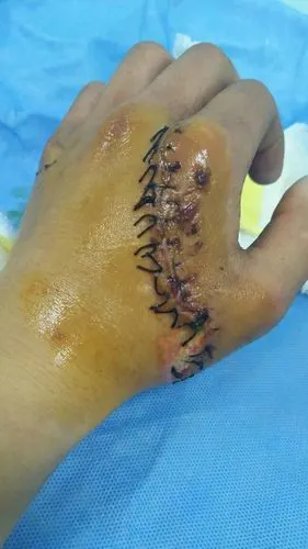 上班被机床伤到左手手背 缝了十几针没伤到骨头 请我我可以得到那些