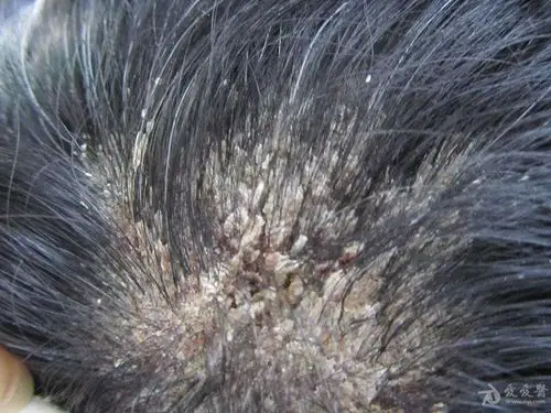 男子头部的皮损——石棉状糠疹