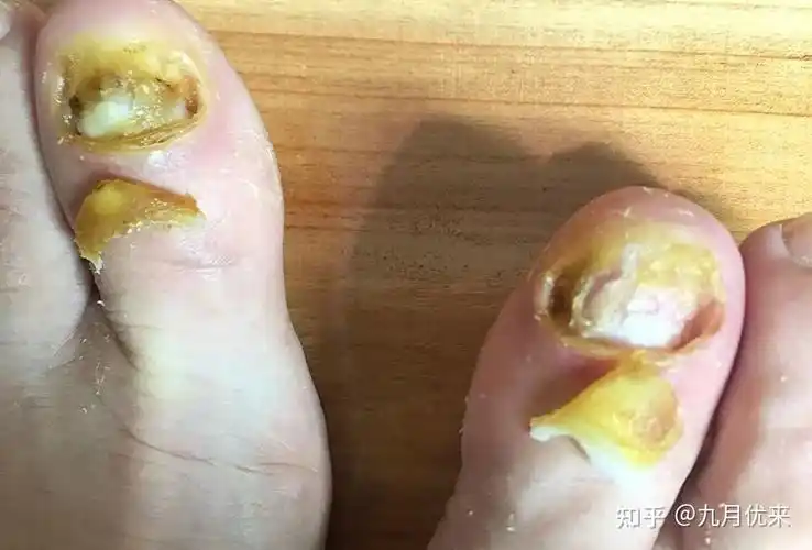 脱甲液脱甲更适合新手