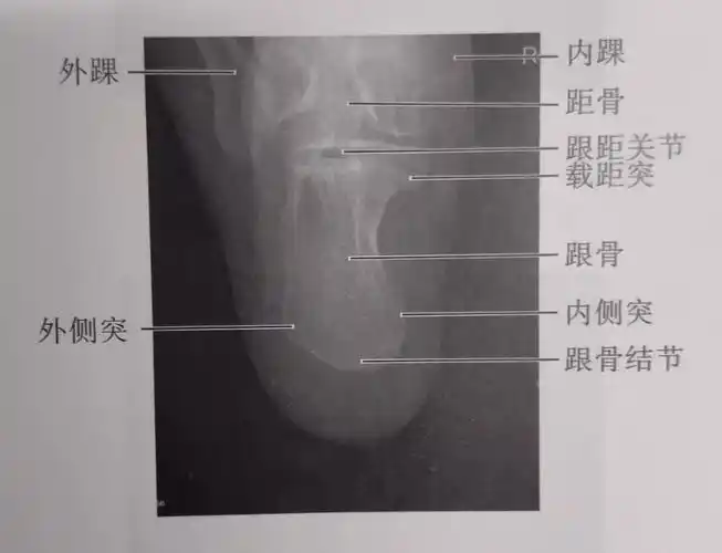 我们来学习巩固解剖下及x线影像下的跟骨是什么样的