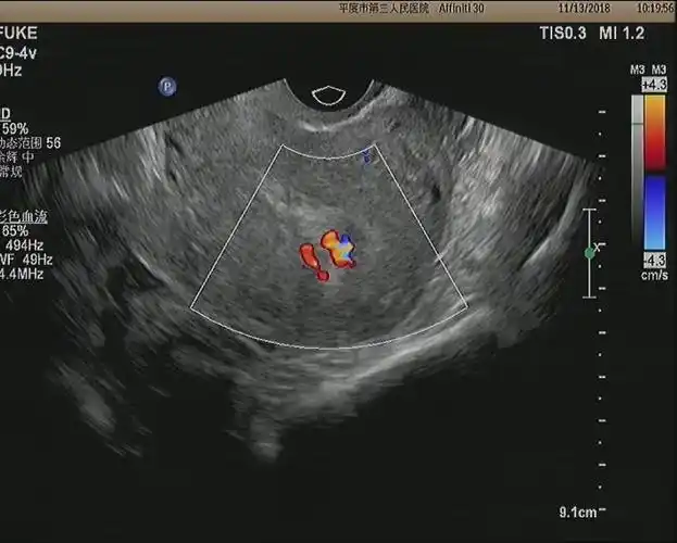 平度市第三人民医院妇科超声检查方法科普小知识