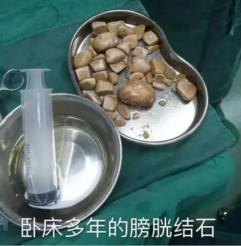 小结石要怎么排出来结石病人症状为什么相差那么大