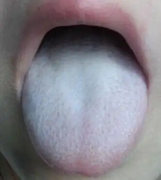 如何看小儿舌苔小儿舌苔案例解读