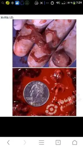 堕胎真相,有图慎进