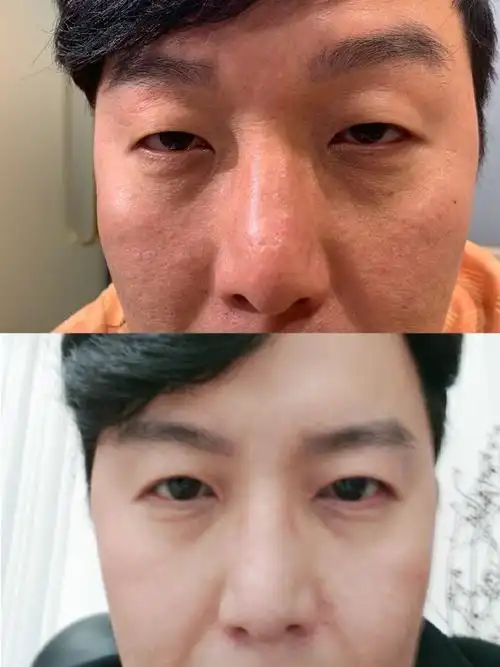 眼皮也越来越垂,感觉不是很舒服,长期戴眼镜也感觉眼睛有些变形了