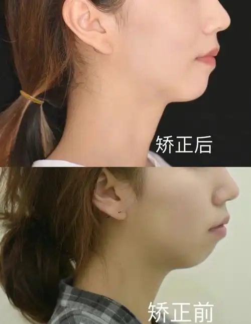 矫正送下巴?骨性嘴凸 下颌后缩青少年案例分享