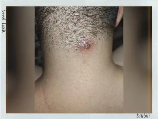 火疖子从开始到手术