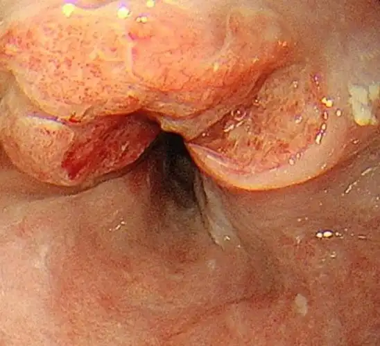 岩手医科大学开发出仅用血液判断食道癌是否复发的方法,可比ct更早