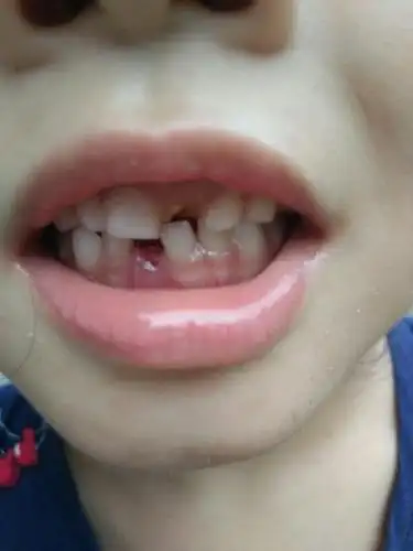 小孩快6岁了,有颗牙齿缺了,现在只剩下根部了,换牙时期前天掉了一颗.