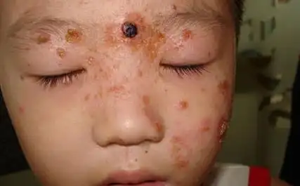 儿童牛皮癣都有哪些症状特点?
