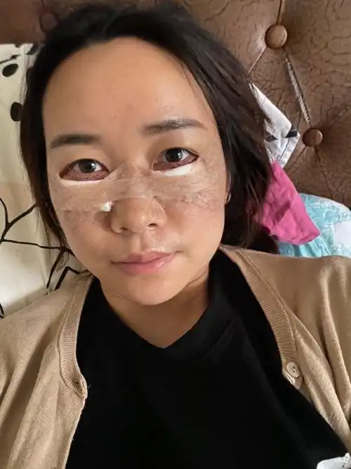 外切 眶隔释放第一天#眶膈释放 #外切眼袋_圈子-新氧美容整形