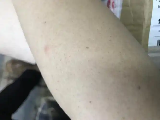 手臂上好多褐色斑点是什么怎么弄