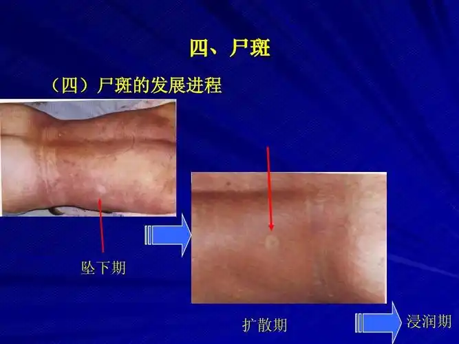 慎入 四,尸斑 (四)尸斑的发展进程 坠下期 扩散期 浸润期