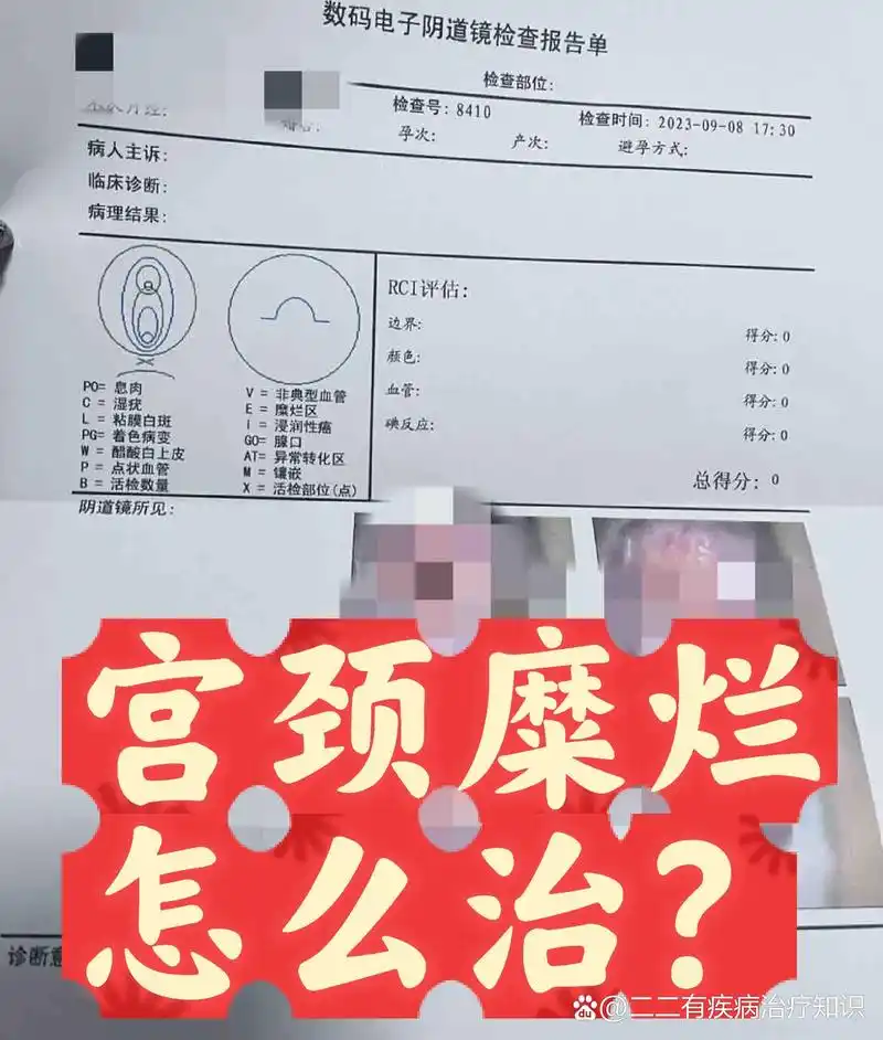br>宫颈炎,宫颈糜烂会自愈吗?要不要治疗?宫颈糜烂怎么治疗最好?