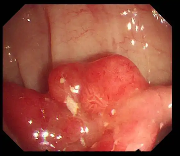 民生实事市中医院顺利完成重点人群结直肠癌肠镜筛查任务