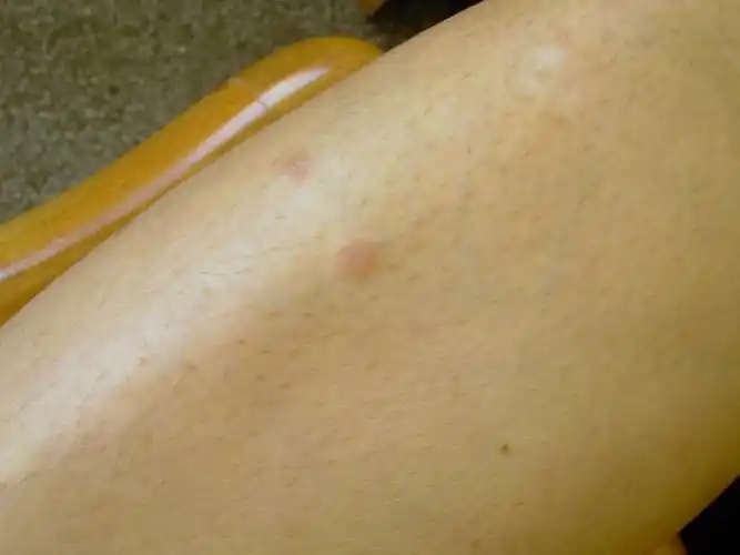 一个奇怪的皮疹(二期梅毒疹) - 皮肤与性传播疾病讨论版 -丁香园论坛