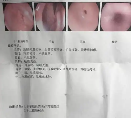 三年前胃窦糜烂,不管不顾,三年后加重病情._手机搜狐网