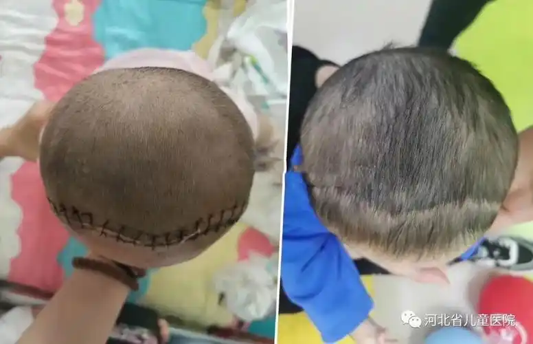 颅骨冠状缝早闭导致的短头畸形开颅手术矫形前后对比所有问题都可以