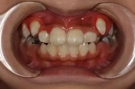 那么,为了防止这些疾病发生,牙齿错位应该怎么矫正呢?