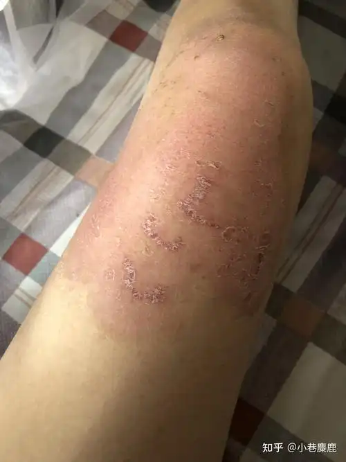 腿部被开水烫伤的恢复记录 - 知乎