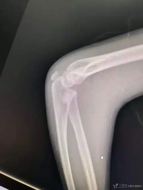 右侧桡骨头小头骨折经皮翘拨复位克氏针弹髓内固定