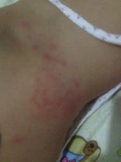 您好,考虑为婴儿湿疹,可能是换了一种纸尿裤导致的局部皮肤过敏所致