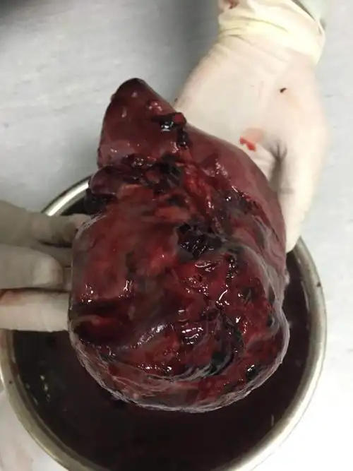 迟发性脾破裂到底可以多迟? - 好大夫在线