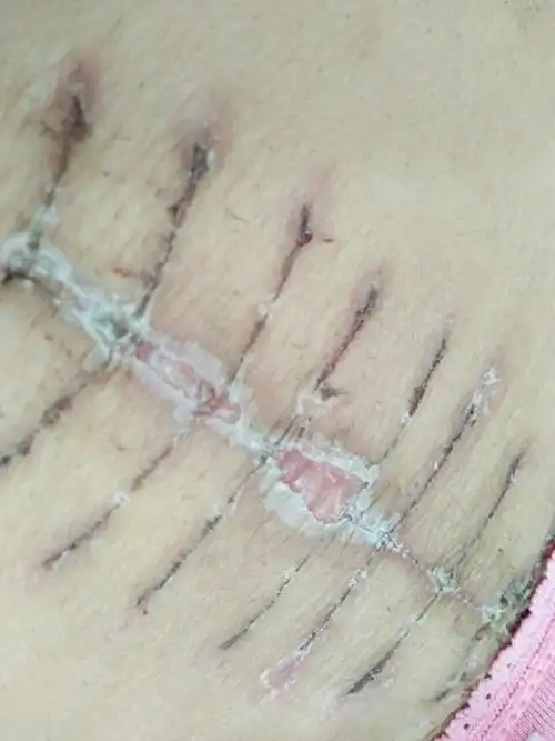 抛妇产18天,竖切口,偶尔肚子有点疼,这样是没恢复好吗?