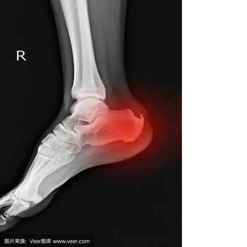 右脚x光片显示跟骨刺呈红色.