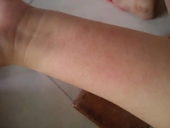 手臂上长了这种红点点,很痒,是什么啊