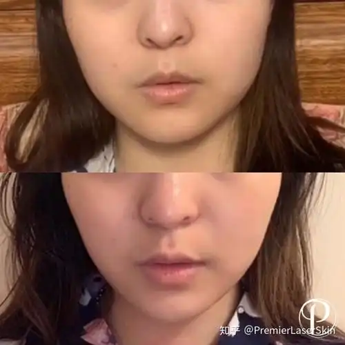 英国伦敦botox肉毒素瘦脸针的术后注意事项 | 医美科普