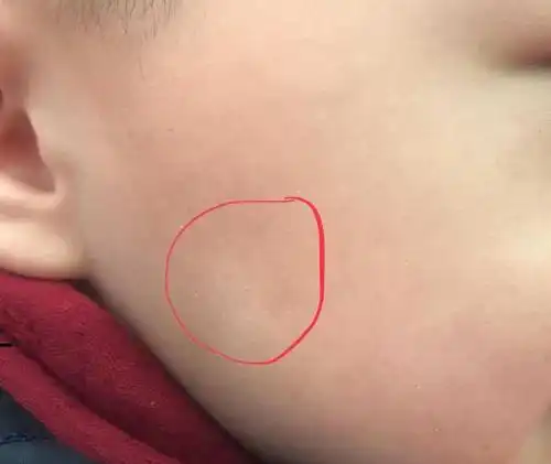 这种白斑在儿童还真的挺常见的,从几岁的小孩子,到10多岁的高中,甚至