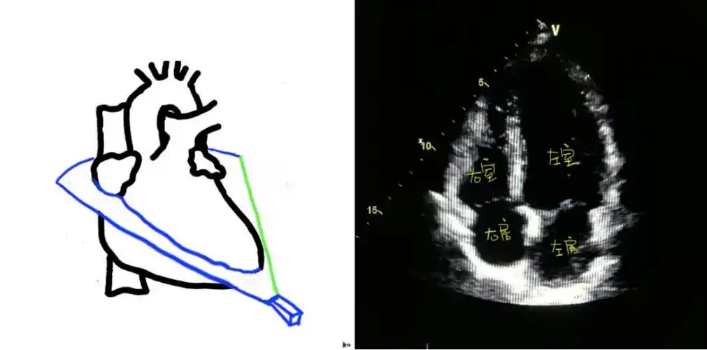图文详解 | 心超切面不会打?看这一篇就够了!
