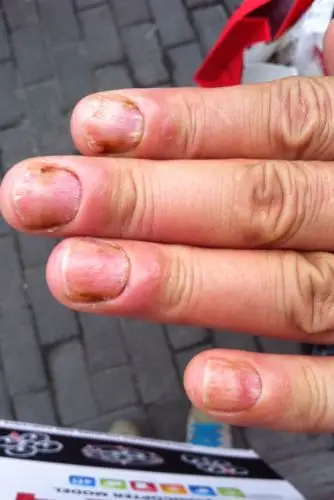 谁能帮我看看这是怎么回事 是灰指甲么?