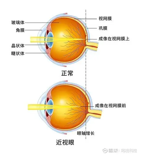 屈光不正是指眼在不使用调节时,平行光线通过眼的屈光作用后,不能在