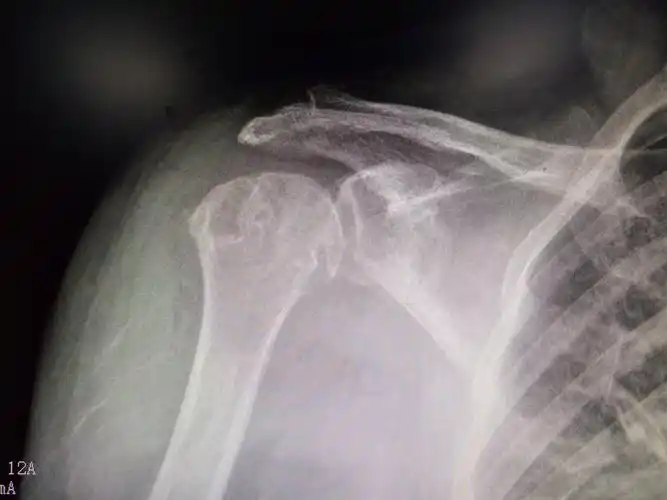 肩痛要及时就诊--陈旧性肩关节脱位病例 - 好大夫在线