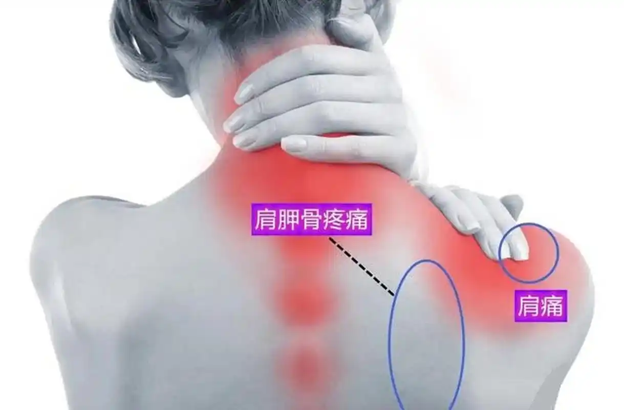 [大哭] 1,能找到痛点——肌肉受损 如果你觉得肩胛骨缝或者肩膀疼痛