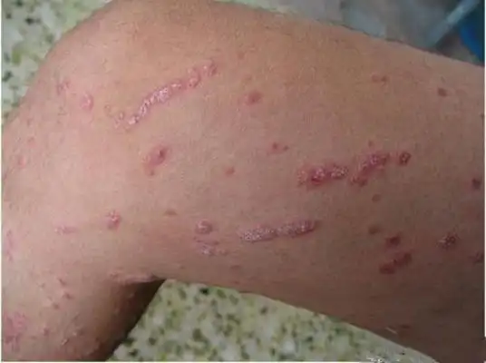 梅毒图片_梅毒症状表现图片大全_有来医生