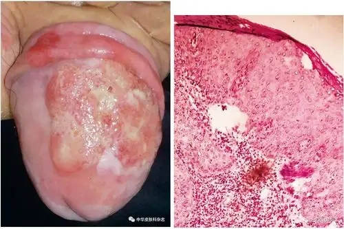人乳头瘤病毒阳性的龟头鳞状上皮细胞癌一例