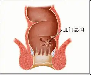 肛门息肉百科_合肥痔疮医院_合肥肛肠医院_合肥肛肠科_合肥瑞金肛肠