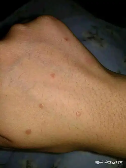 手背手臂长了扁平疣怎么办,怎么治疗才不会留疤